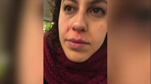 El rostro de Lihi Aharon después del ataque