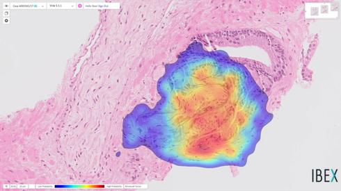 Una imagen de cáncer de próstata (representada por un mapa de calor) detectada por la solución Ibex Galen en una biopsia que el patólogo había diagnosticado antes como benigna. 