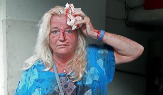 Mujer herida luego de la explosión en Beirut. 