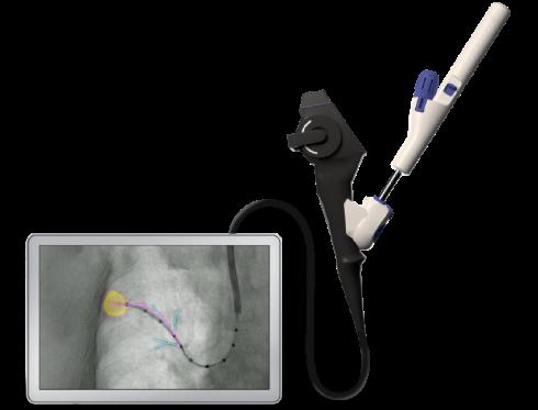 El sistema LungVision de Body Vision Medical en pleno funcionamiento. 