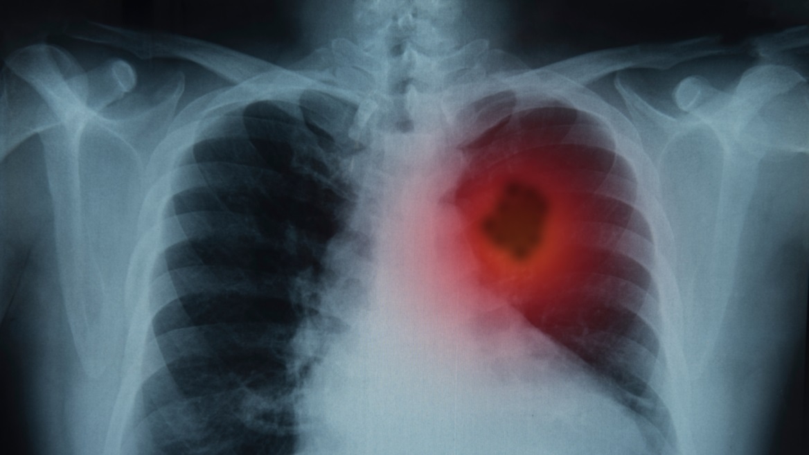 Imagen de un cáncer de pulmón. Las imágenes no logran ver todo para poder tratar la enfermedad de manera temprana. 
