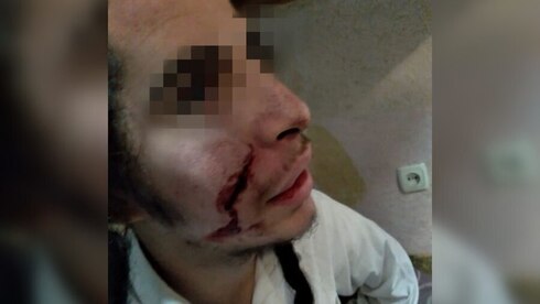 Herida cortante en el rostro del joven judío atacado en Uman. 