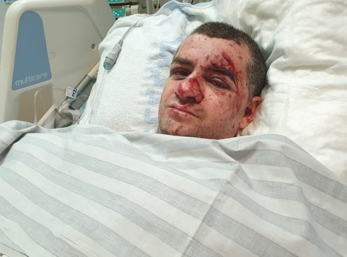 Edward Weinstock tras resultar herido por el impacto de un misil en su apartamento de Ashkelon.