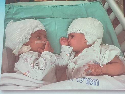 Hermanas siamesas separadas mediante cirugía en el hospital Soroka. (Centro Médico Soroka) Las hermanas pueden verse una a la otra por primera vez tras la exitosa cirugía en el Centro Médico Soroka.