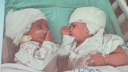 Las hermanas pueden verse una a la otra por primera vez tras la exitosa cirugía en el Centro Médico Soroka.