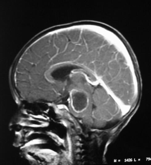 El análisis rápido de tomografías cerebrales puede salvar vidas. 