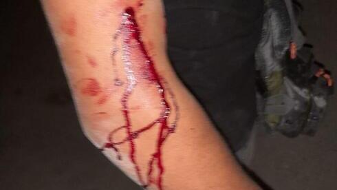 El brazo herido de uno de los hermanos.