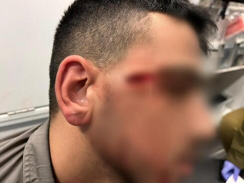 El soldado que sufrió heridas leves en el ojo. 
