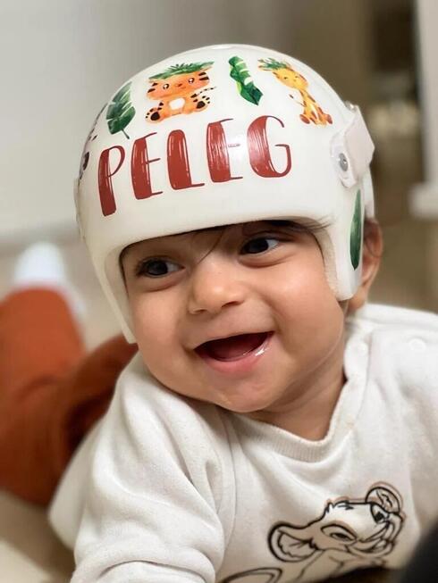 Niño israelí obtiene una nueva calidad de vida a partir de un tratamiento  con casco